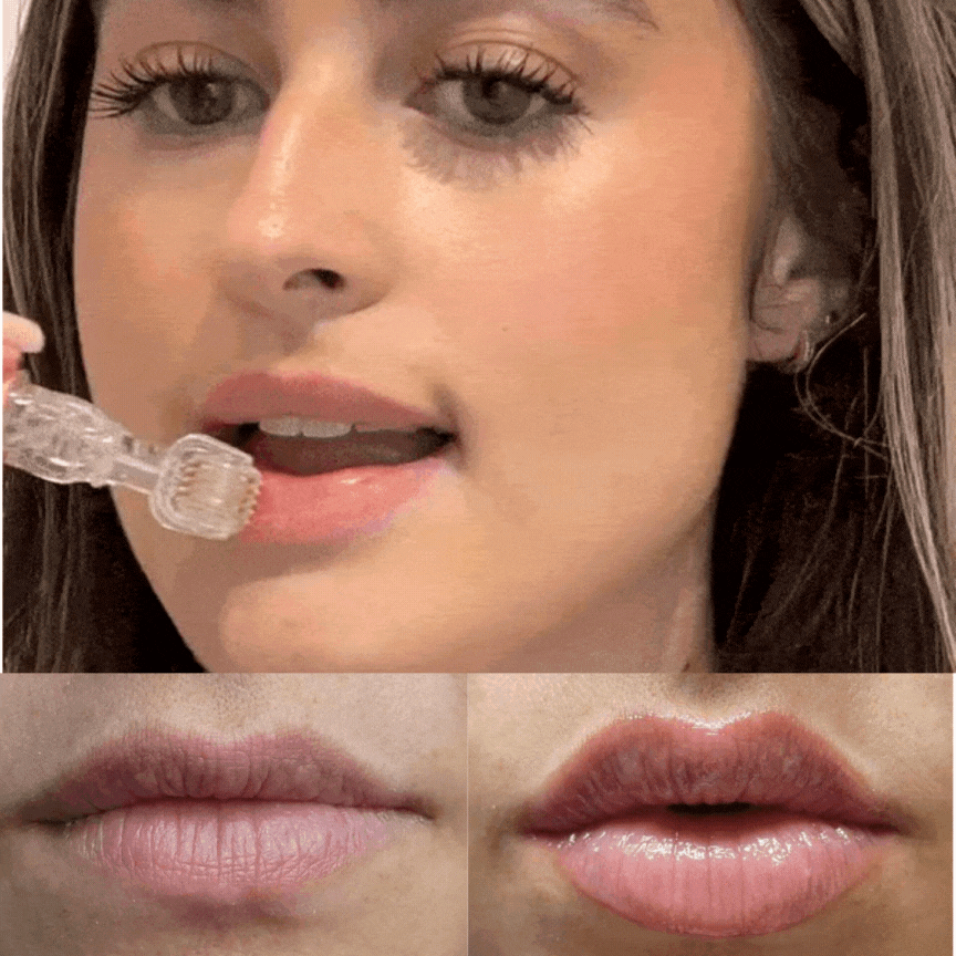 Lip Roller Kit